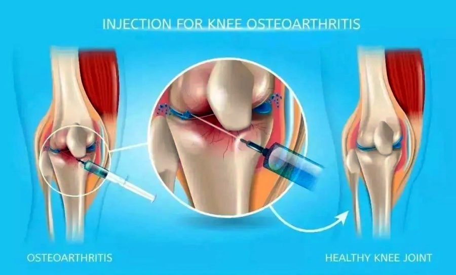 中國骨關節炎診療指南（2024版）發布，干細胞關節內腔注射被推薦使用